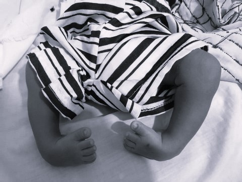  Pied bot en Guinée : une malformation fréquente mais soignable chez l’enfant